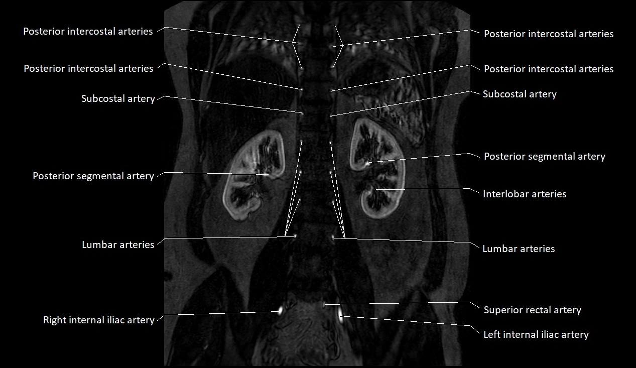 MRA Abdomen coronal anatomy image 37.webp